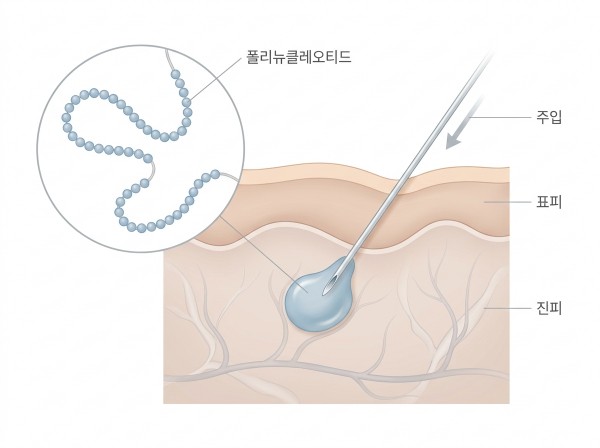 기존 힐러가 따끔했던 건 걸쭉한 PN 제형에 마취 성분이 없던 구조 때문이지, 환자가 예민해서가 아니다 - 김해리쥬란hb | 미미썸의원 김해점