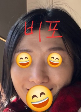 눈가이마등 실리프팅 등