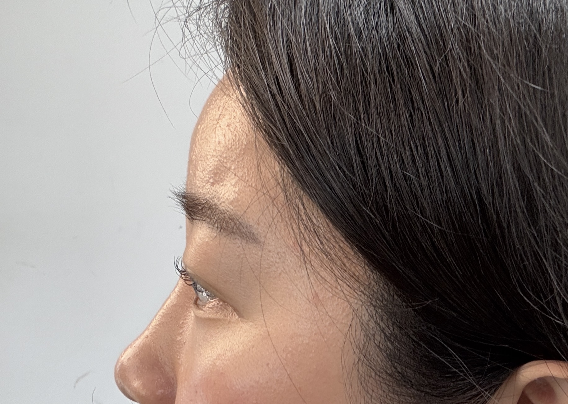 이마필러 잘하는곳