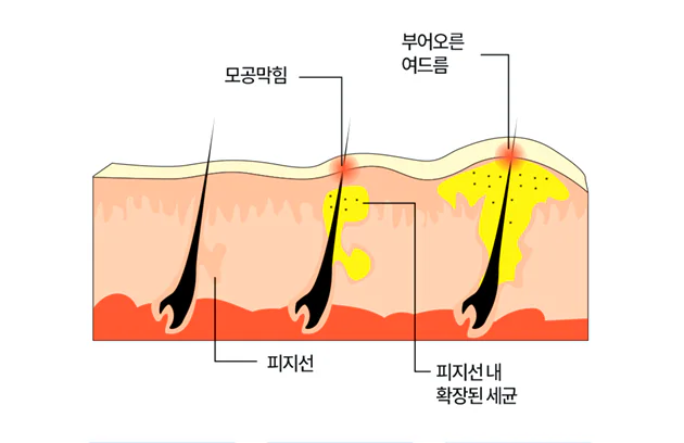모공막힘, 부어오른 여드름, 피지선, 피지선 내 확장된 세균 이미지